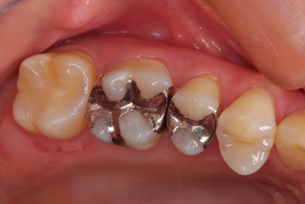 銀 歯 と 白い 詰め物 の 違い